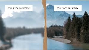 Vue avec et sans cataracte